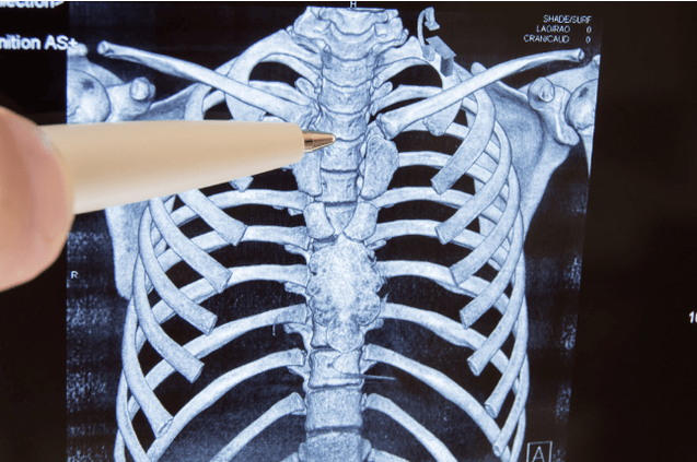 Osteochondrozė