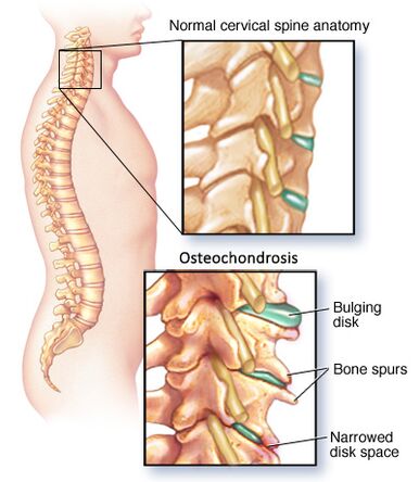 gimdos kaklelio osteochondrozė