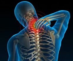 kaklo stuburo osteochondrozė