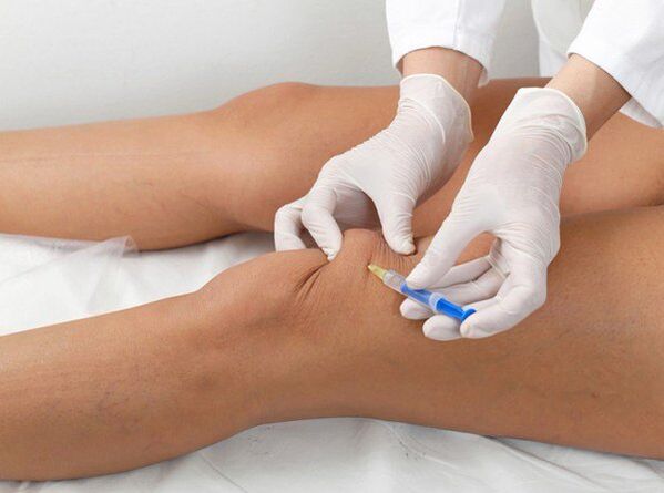 Intrasąnarinė injekcija kelio artrozei gydyti