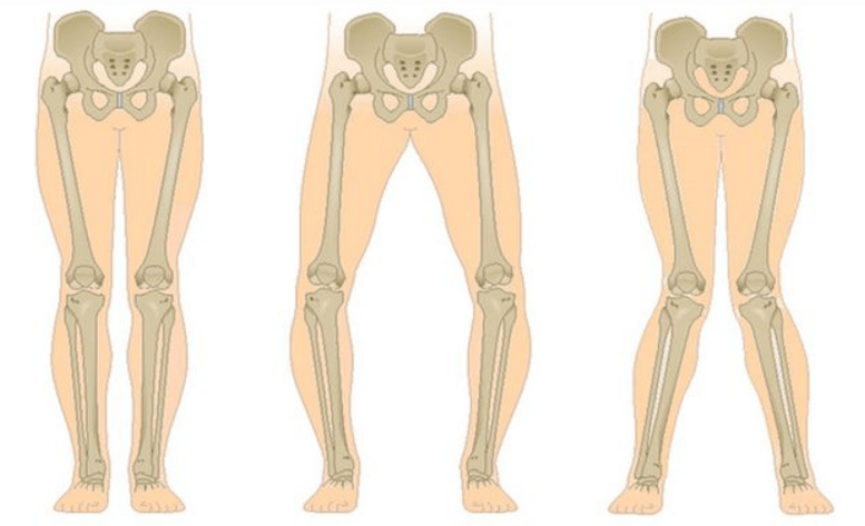 kelio artrozės komplikacijos